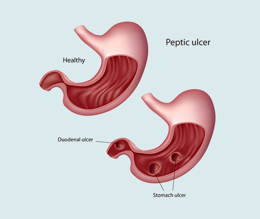 Duodenal Ulcer Treatment
