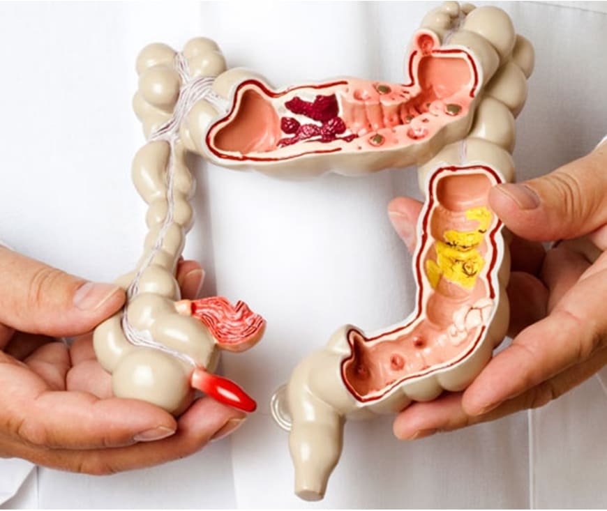 Irritable bowel syndrom
