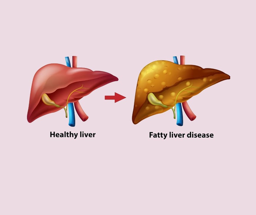 Fatty Liver Disease Treatment