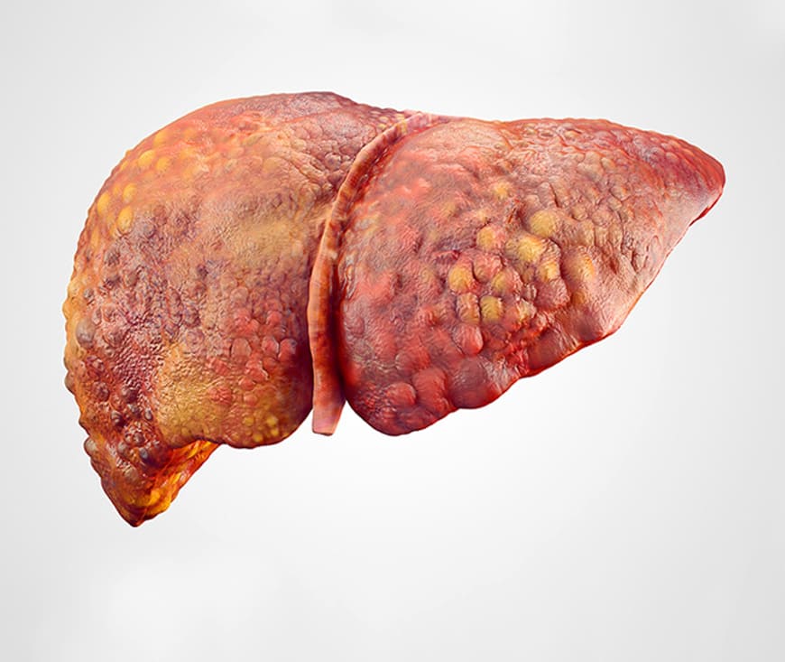  Liver Cirrhosis Treatment